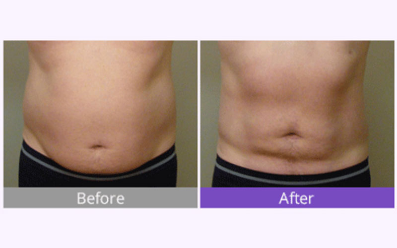 body contouring weightloss and skin tightening